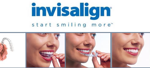 Invisalign Richmond, Money Off Invisalign